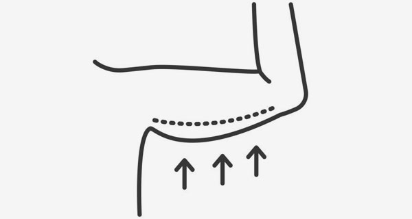 Kol Germe Ameliyatı: Sarkık Kollara Kalıcı Çözüm Mümkün mü?